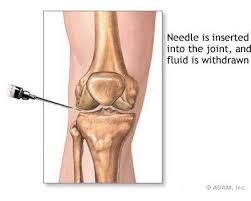 Cold weather affect joints: Survey